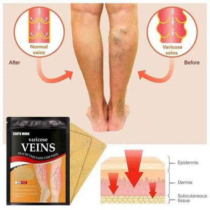 parche para venas varices